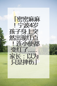 密密麻麻！宁波4岁孩子身上突然出现红点！连小便都变红了……家长：以为只是摔伤